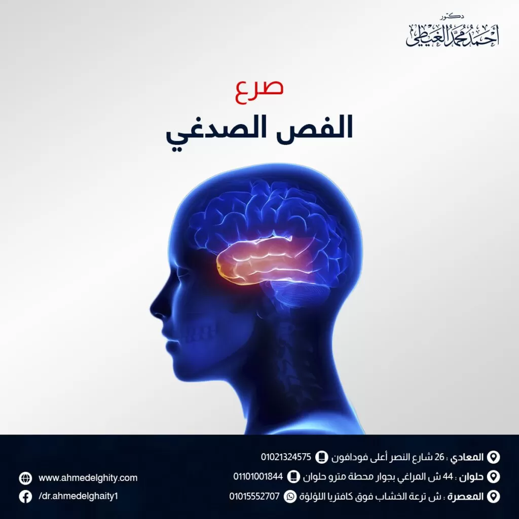 صرع الفص الصدغي