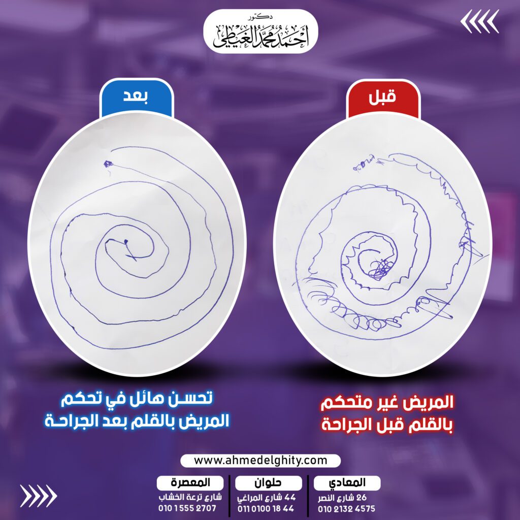 قصة نجاح علاج مرض باركنسون