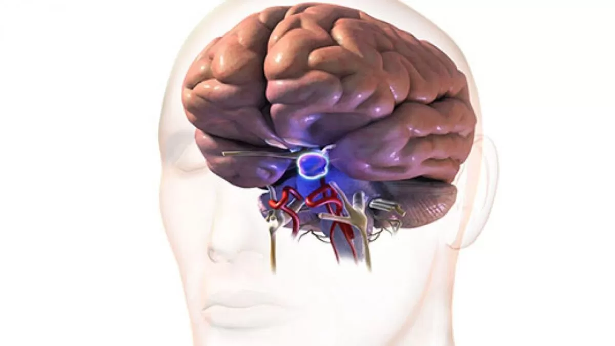 كيف يمكن اكتشاف ورم الدماغ؟