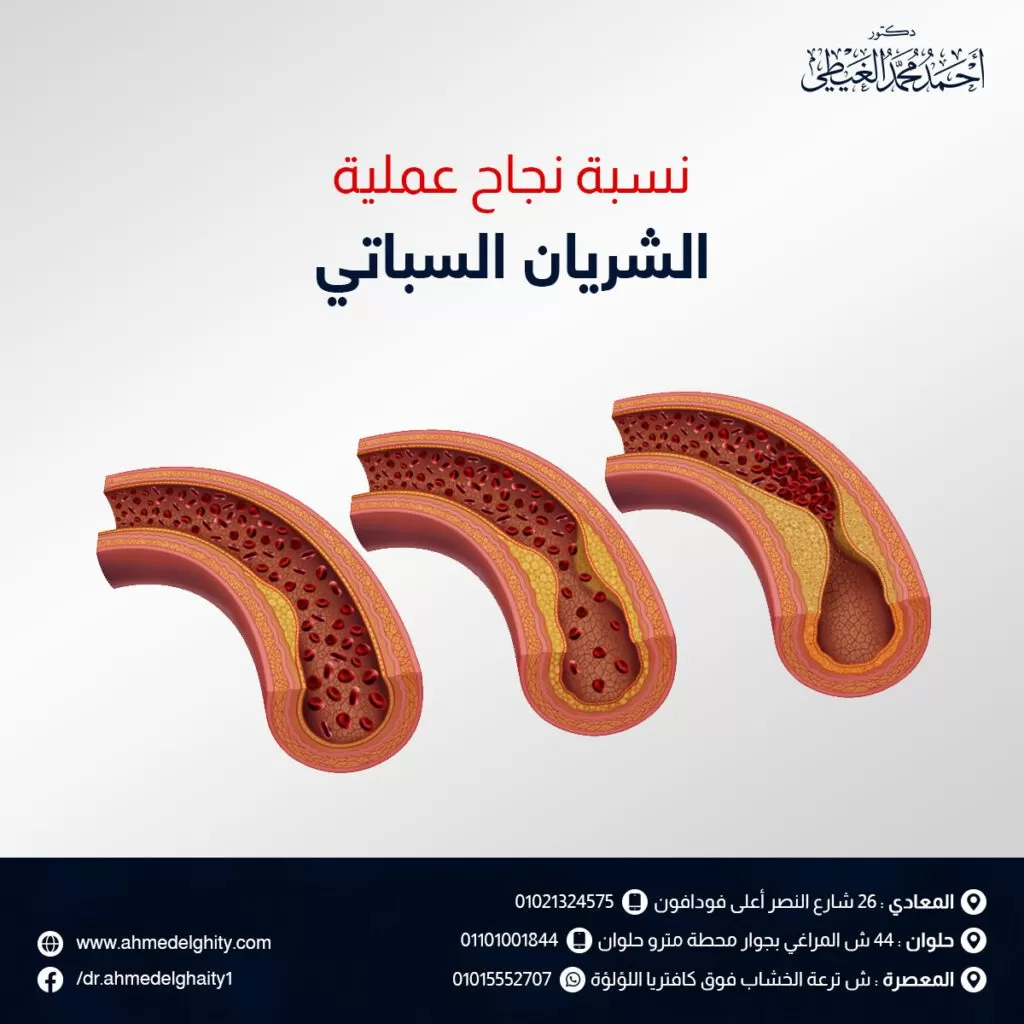 نسبة نجاح عملية الشريان السباتي