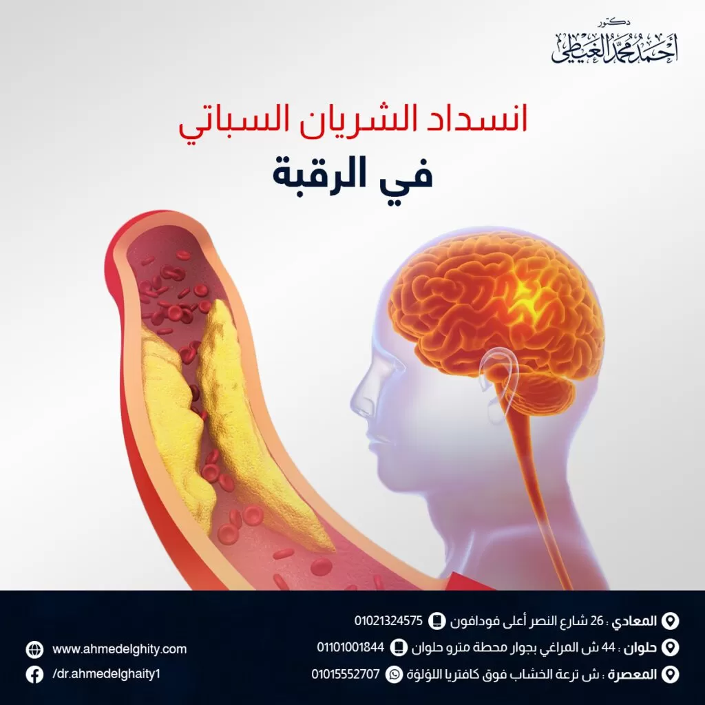 أعراض انسداد الشريان السباتي في الرقبة