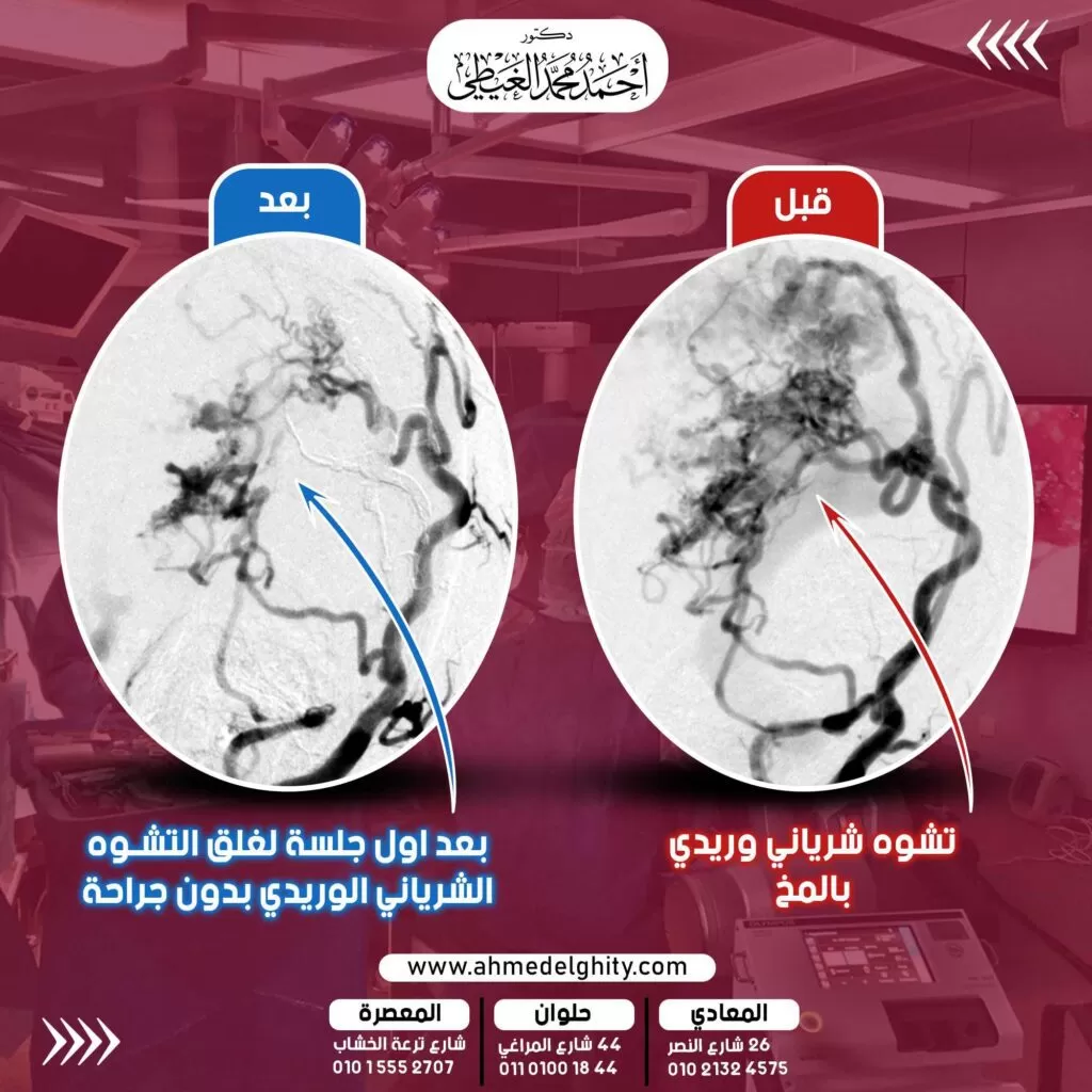تشوه شرياني وريدي بالمخ