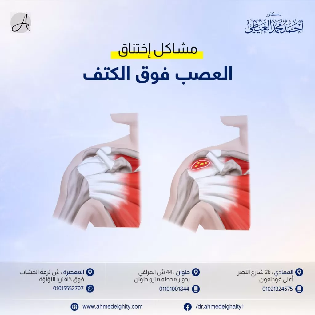 مشاكل اختناق العصب فوق الكتف