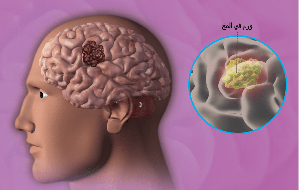 نسبة الشفاء من ورم الدماغ الحميد