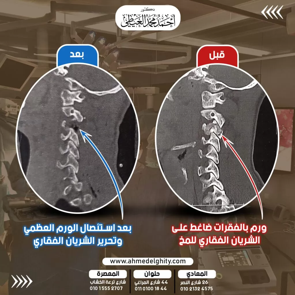 ورم بعظم الفقرات العنقية
