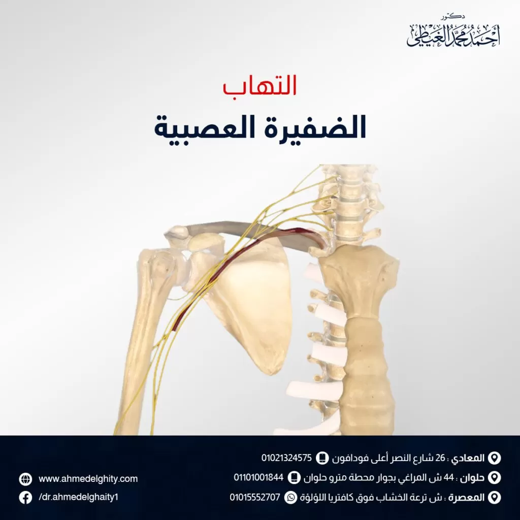 التهاب الضفيرة العصبية