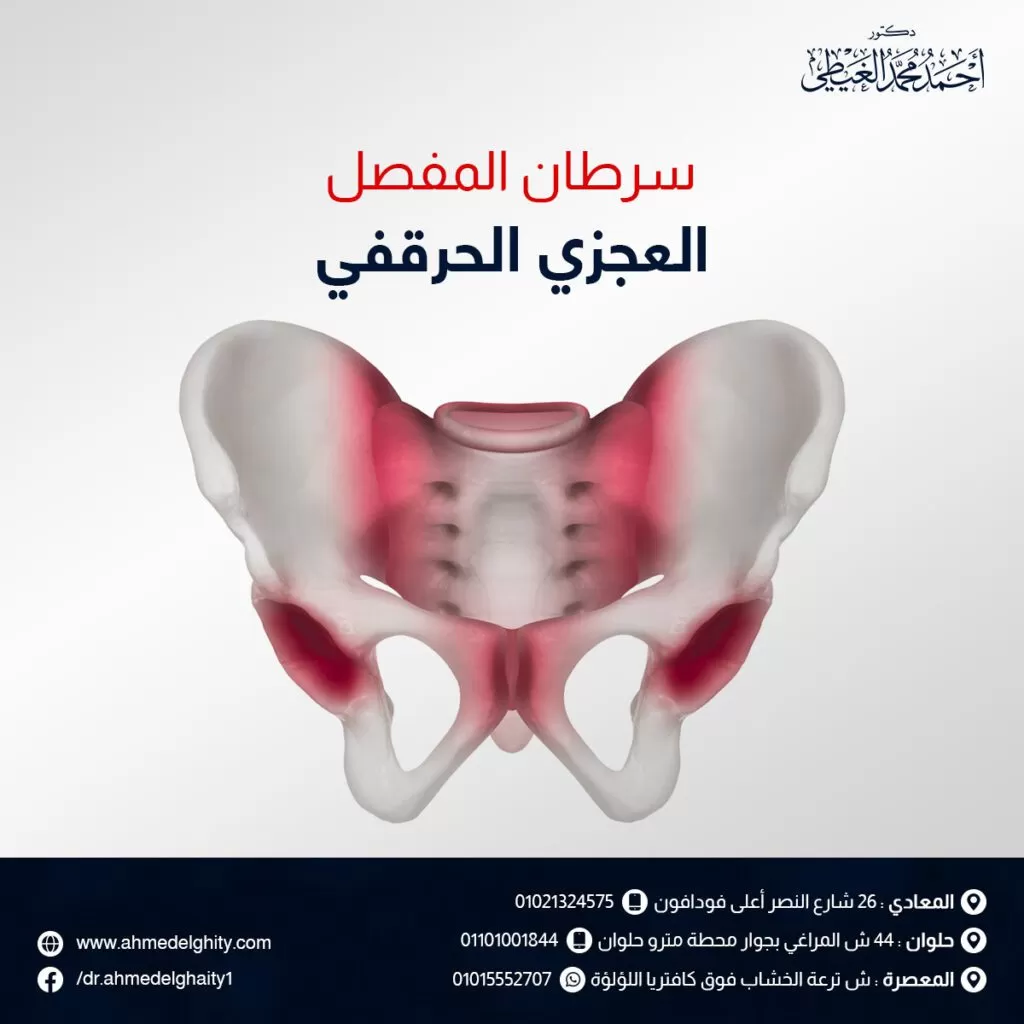 سرطان المفصل العجزي الحرقفي