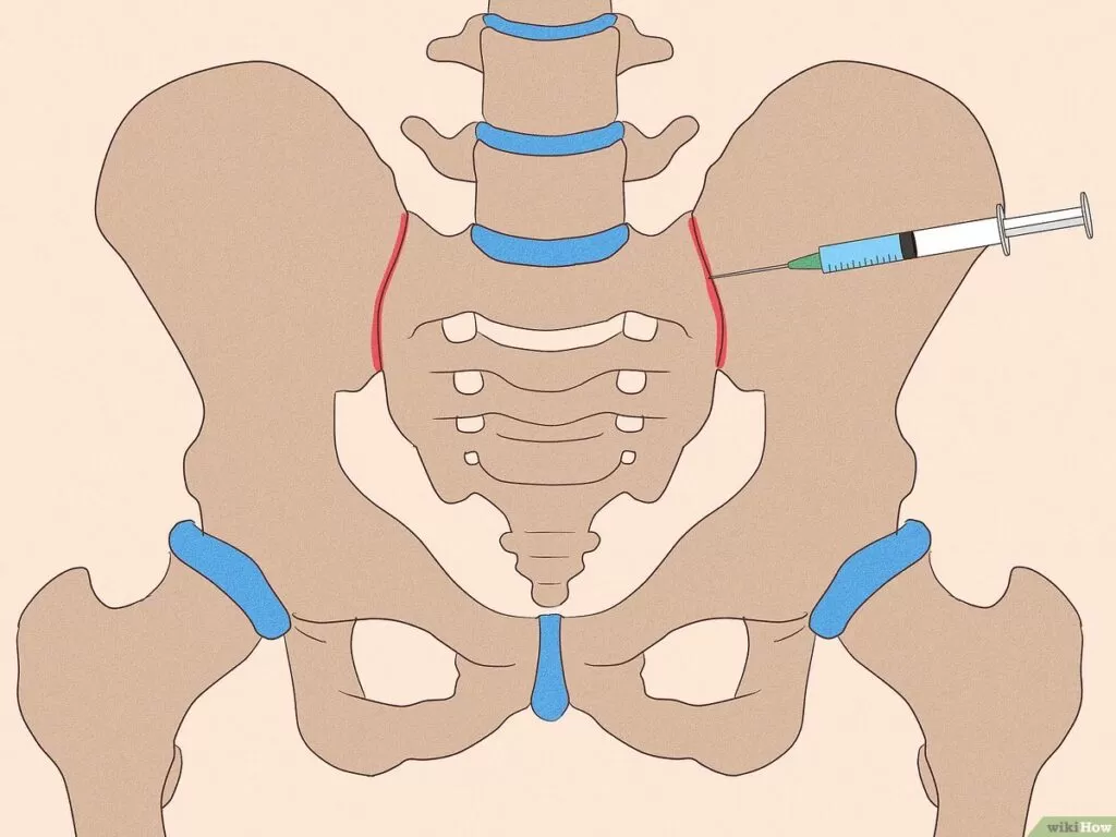 علاج التهاب المفصل العجزي الحرقفي