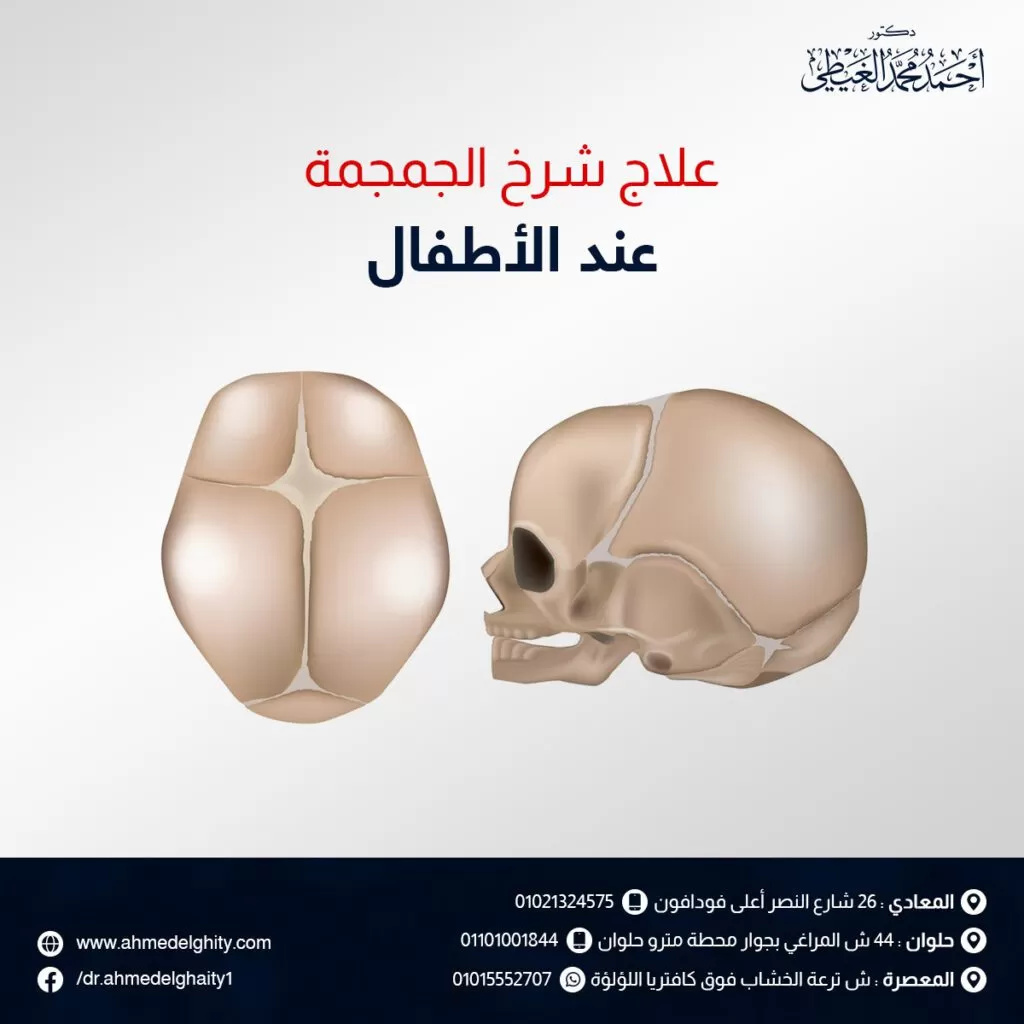 علاج شرخ الجمجمة عند الأطفال