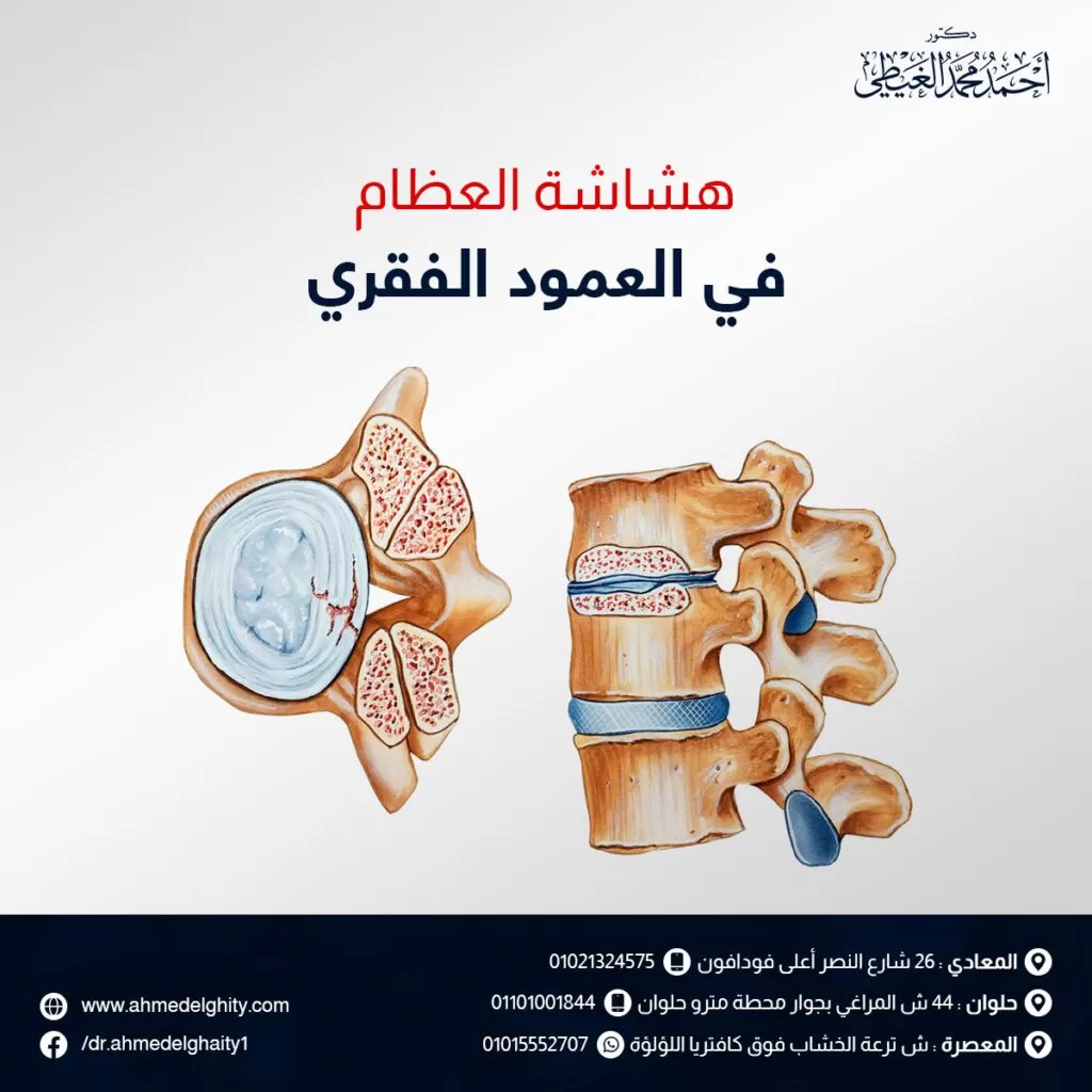 هشاشة العظام في العمود الفقري