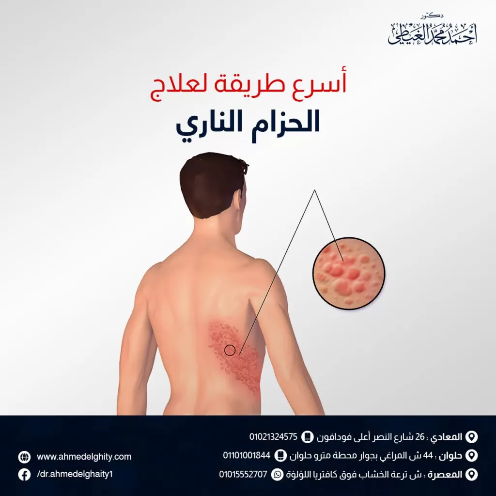 أسرع طريقة لعلاج الحزام الناري