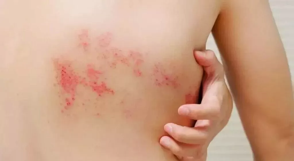 أسرع طريقة لعلاج الحزام الناري