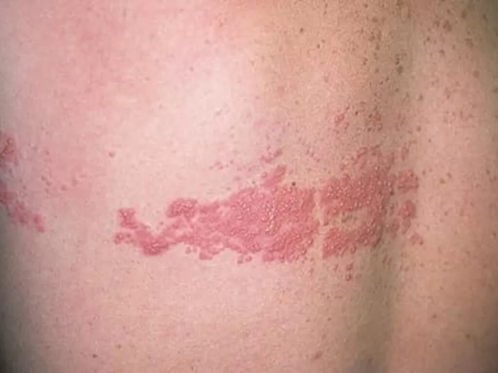 العلاجات البديلة للقوباء المنطقية