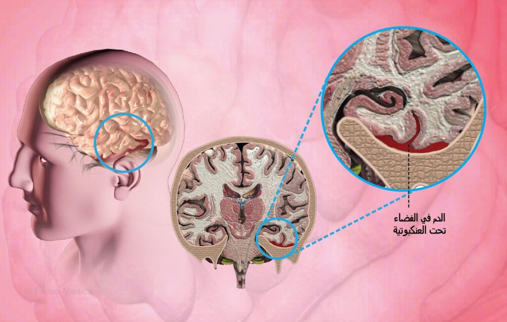 أعراض استسقاء المخ بعد نزيف الأم العنكبوتية