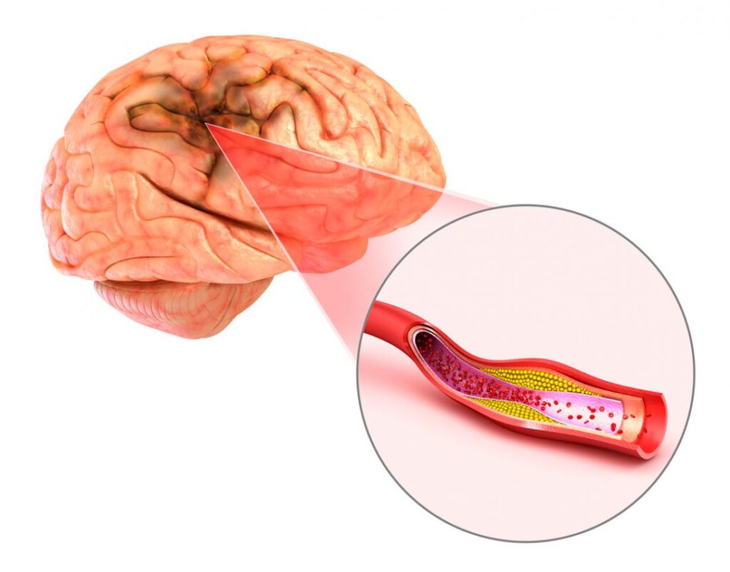 أعراض تمزق الأوعية الدموية في الدماغ