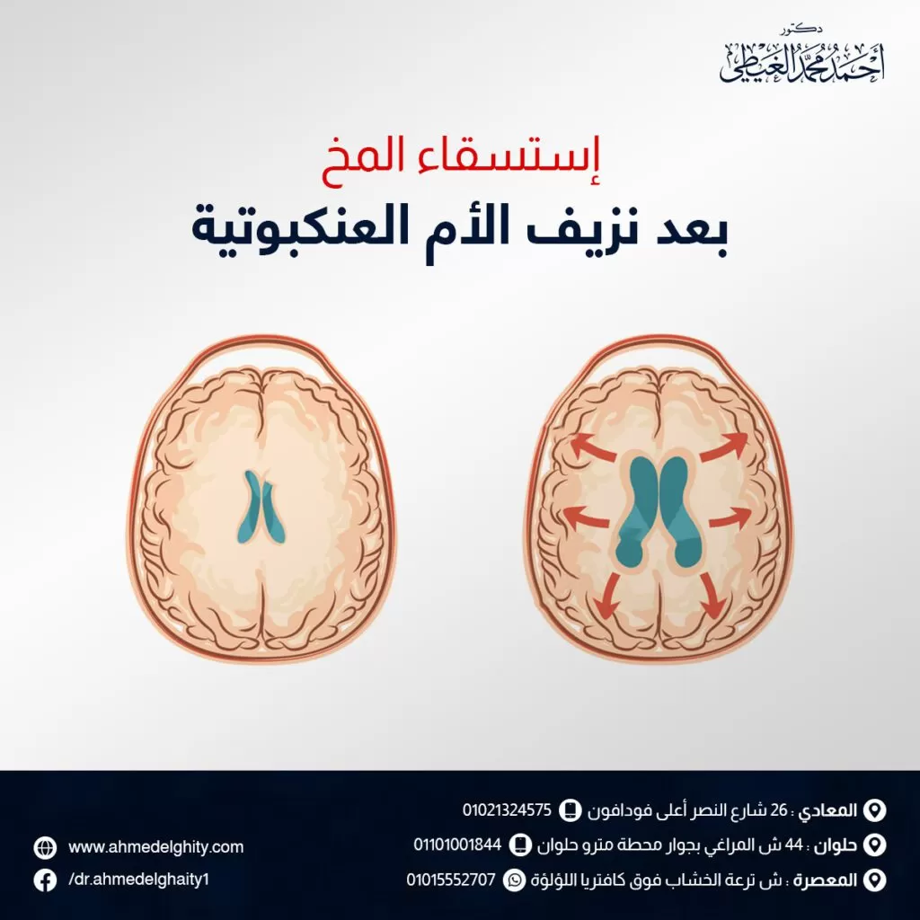 استسقاء المخ بعد نزيف الأم العنكبوتية