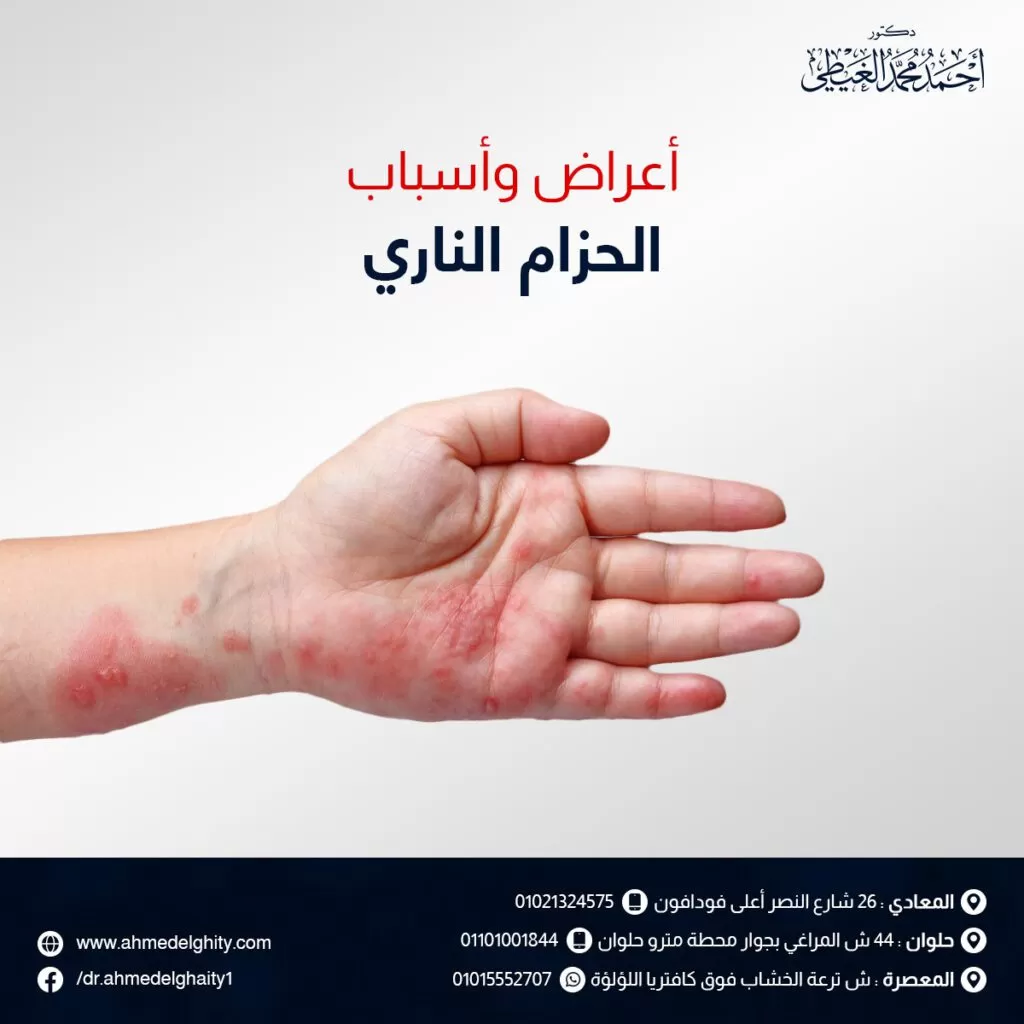 اعراض واسباب الحزام الناري