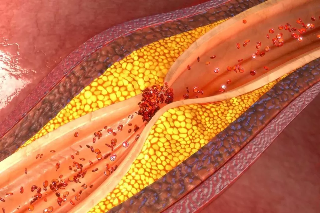 الأعراض التي تدل على حدوث تصلب في شرايين المخ