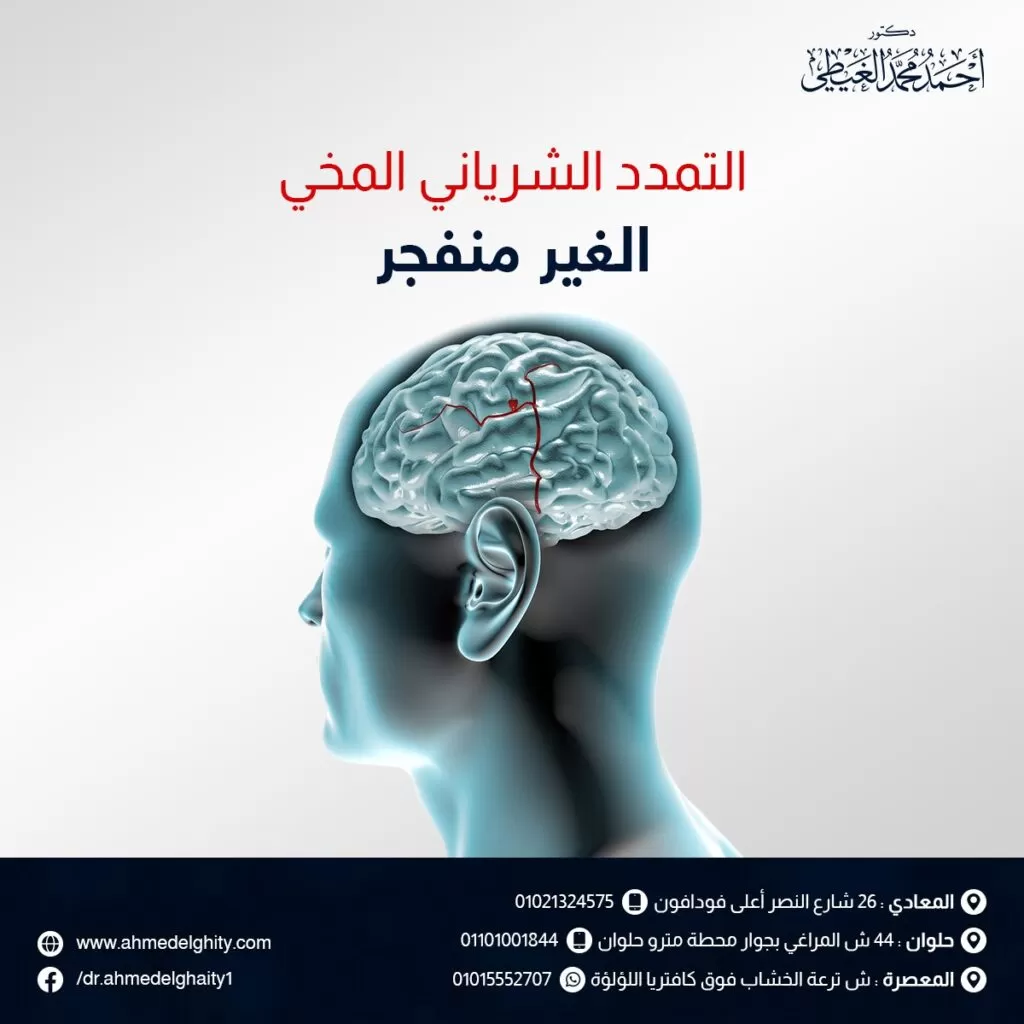 التمدد الشرياني المخي الغير منفجر