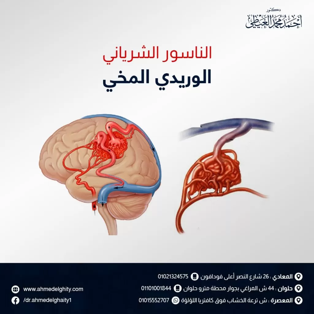 الناسور الشرياني الوريدي المخي
