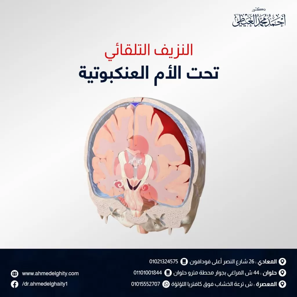 النزيف التلقائى تحت الأم العنكبوتية