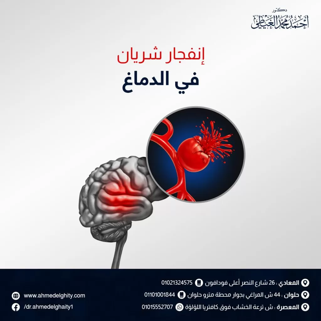 انفجار شريان في الدماغ