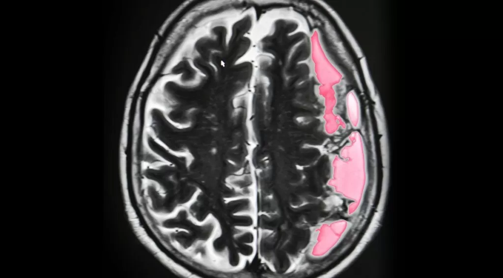 حالات شفيت من نزيف الدماغ