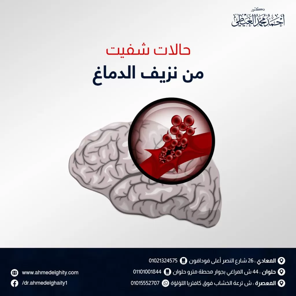 حالات شفيت من نزيف الدماغ