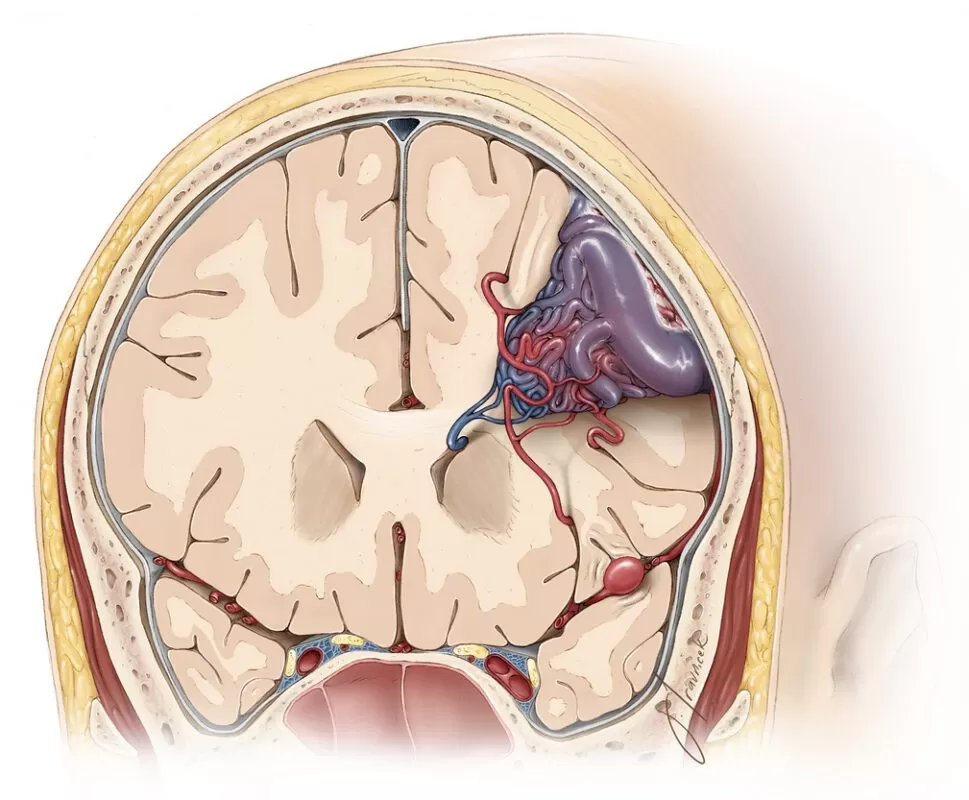 علاج انفجار شريان في الدماغ