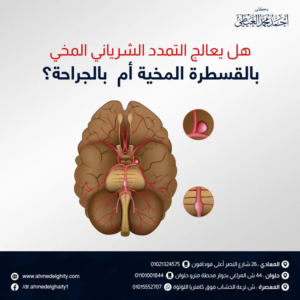 هل يعالج التمدد الشرياني المخي بالقسطرة المخية أم  بالجراحة؟