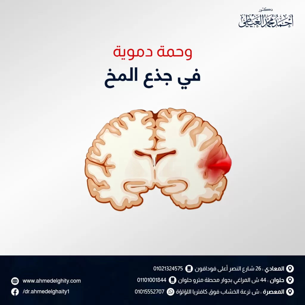 وحمة دموية في جذع المخ