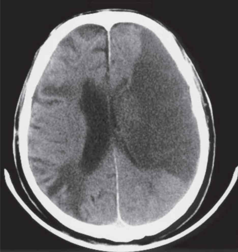 أعراض مرض المادة البيضاء في الدماغ