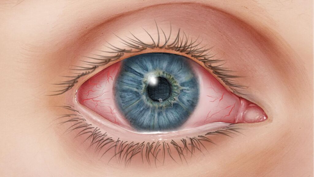 أنواع التهاب العصب البصري