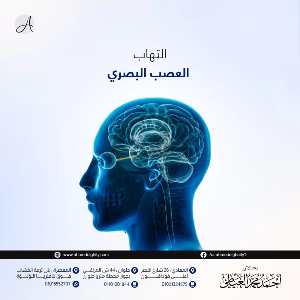 التهاب عصب العين