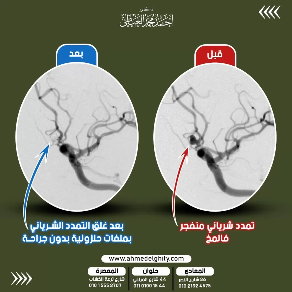 انفجار تمدد شرياني بالمخ