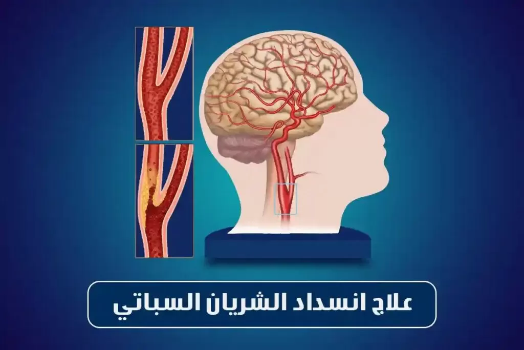 علاج انسداد الشريان السباتي