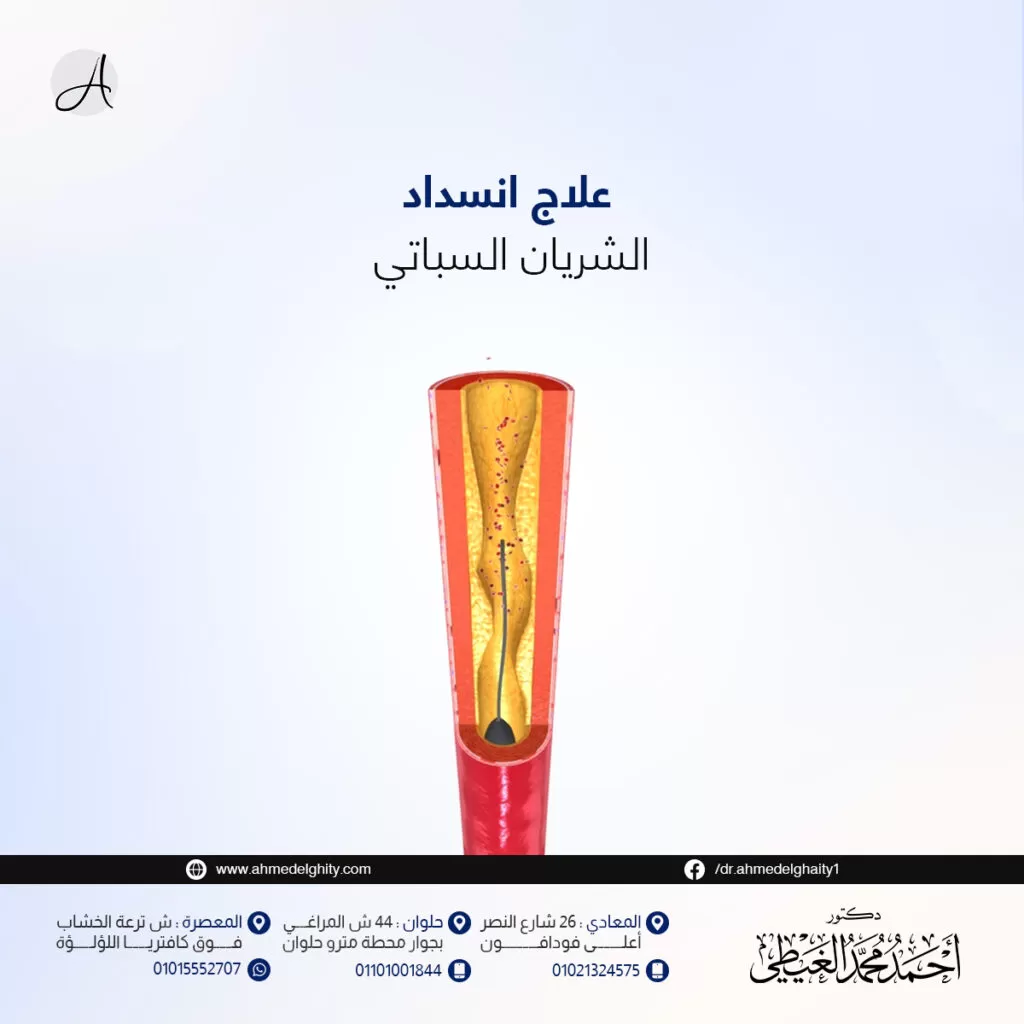 علاج انسداد الشريان السباتي