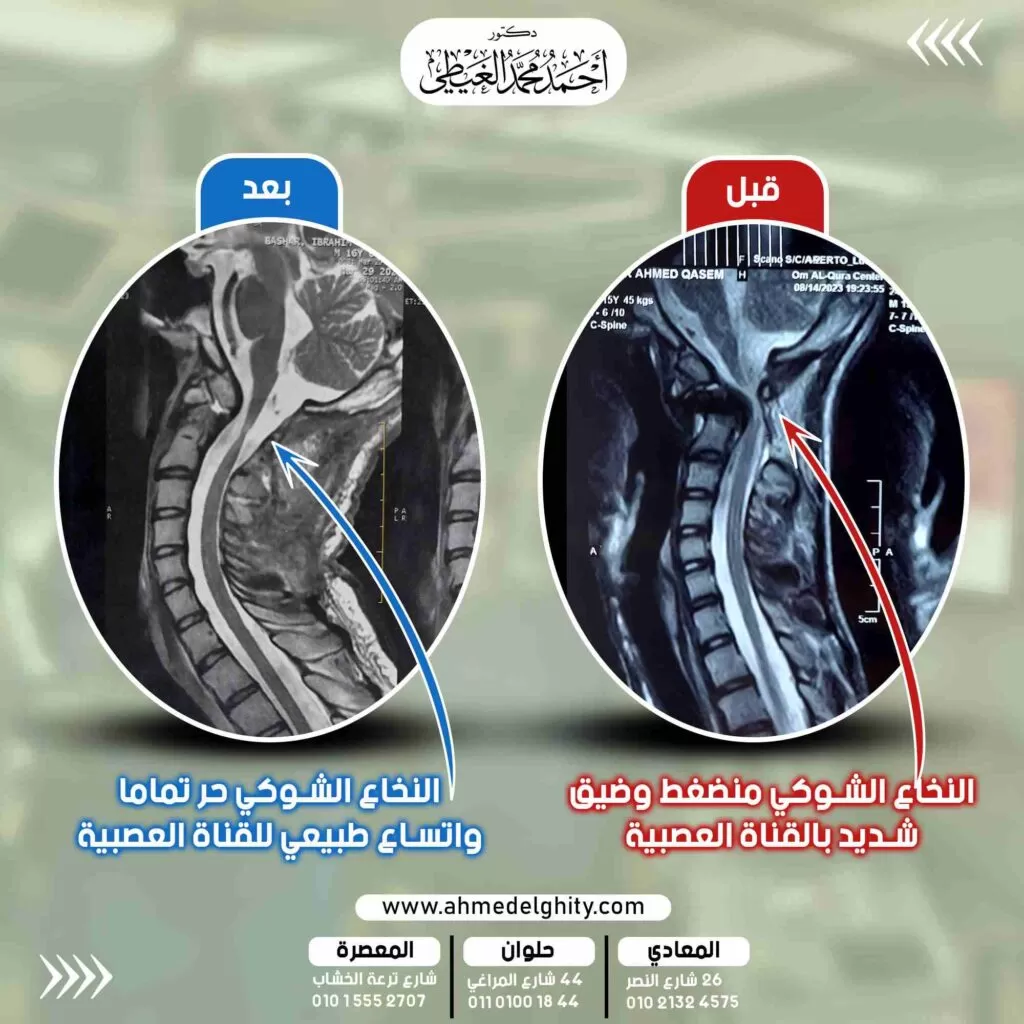 عملية جراحة شلل رباعي متزايد