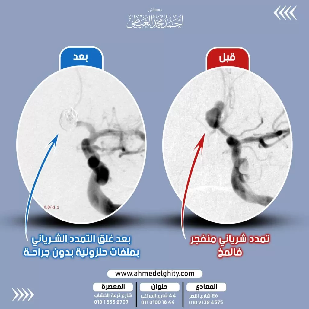 غلق انفجار تمدد شرياني بالمخ لمريض