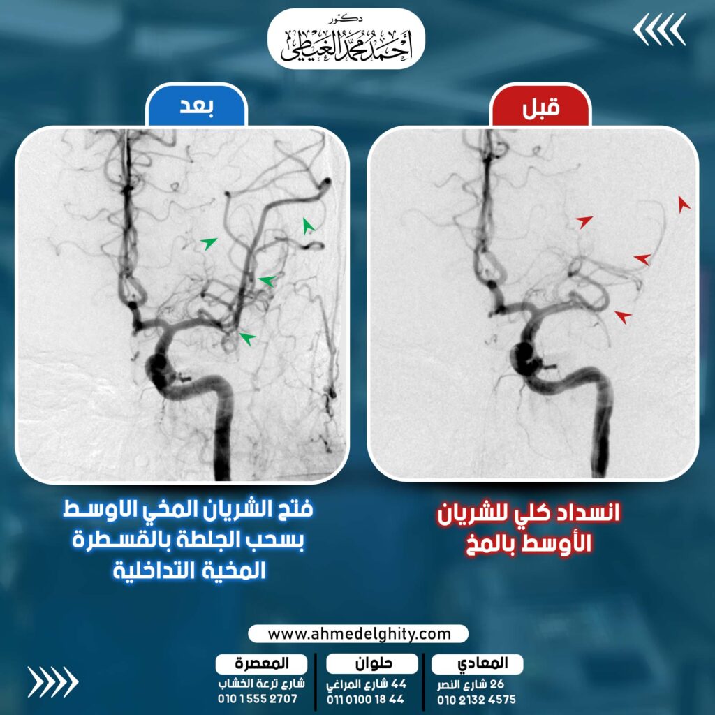 إنقاذ مريضة تعاني من شلل نصفي في النصف الأيمن من الجسم