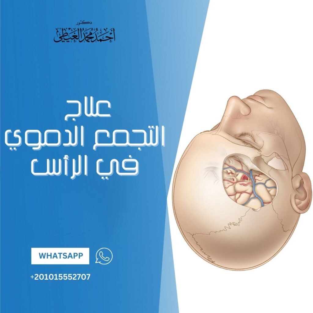 علاج التجمع الدموي في الرأس 