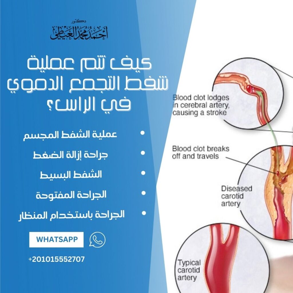 كيف تتم عملية شفط التجمع الدموي في الراس؟ 