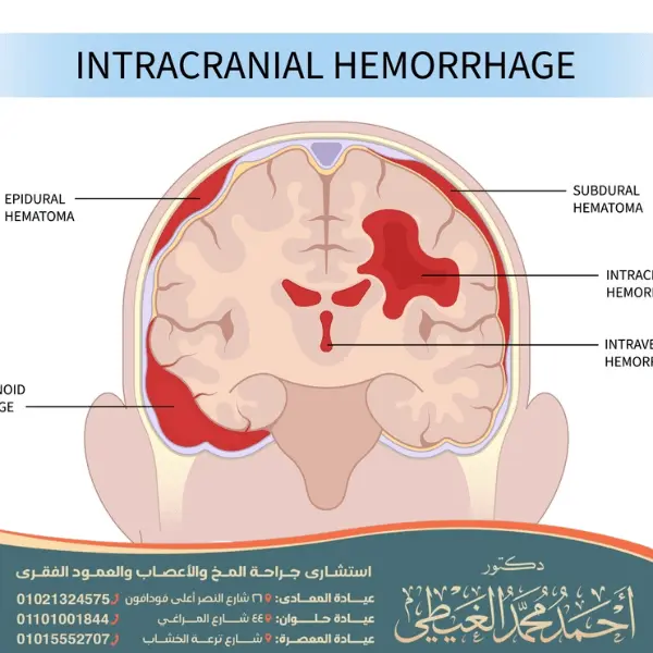 أفضل دكتور لعلاج الجلطة الدماغية 