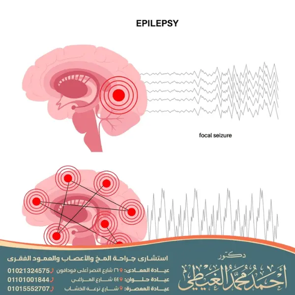 أفضل دكتور لعلاج الصرع في مصر