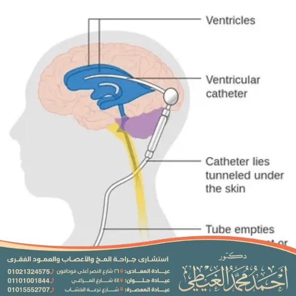 دكتور قسطرة مخية