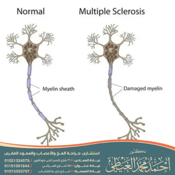 دكتور متخصص في مرض MS