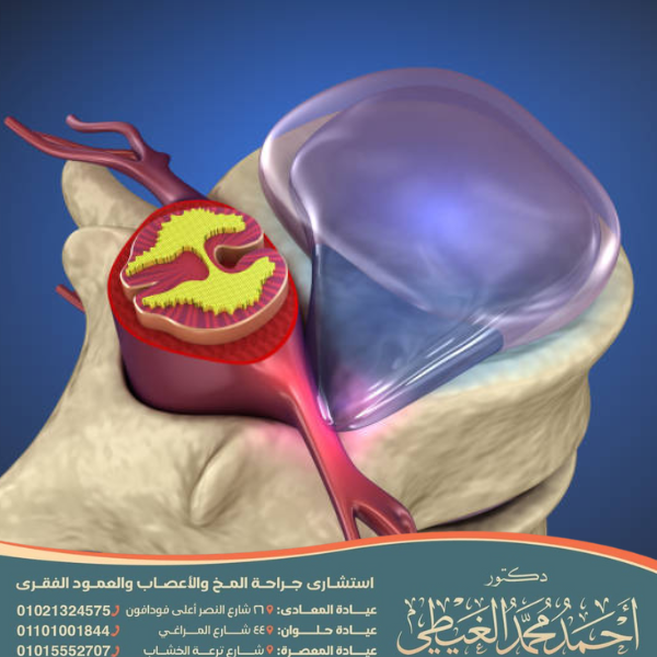 علاج الديسك الضاغط على العصب