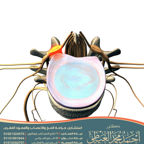 علاج الديسك الضاغط على العصب