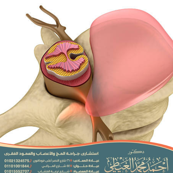علاج الديسك الضاغط على العصب