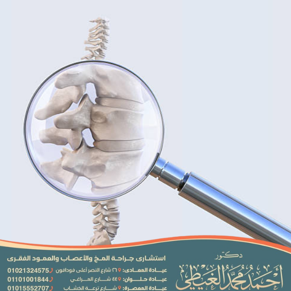 علاج كسر فقرة الظهر